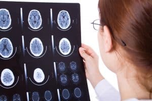 Why Your Auto Accident Brain Injuries Must Get the Attention They Deserve 64528d4cf0f55.jpeg